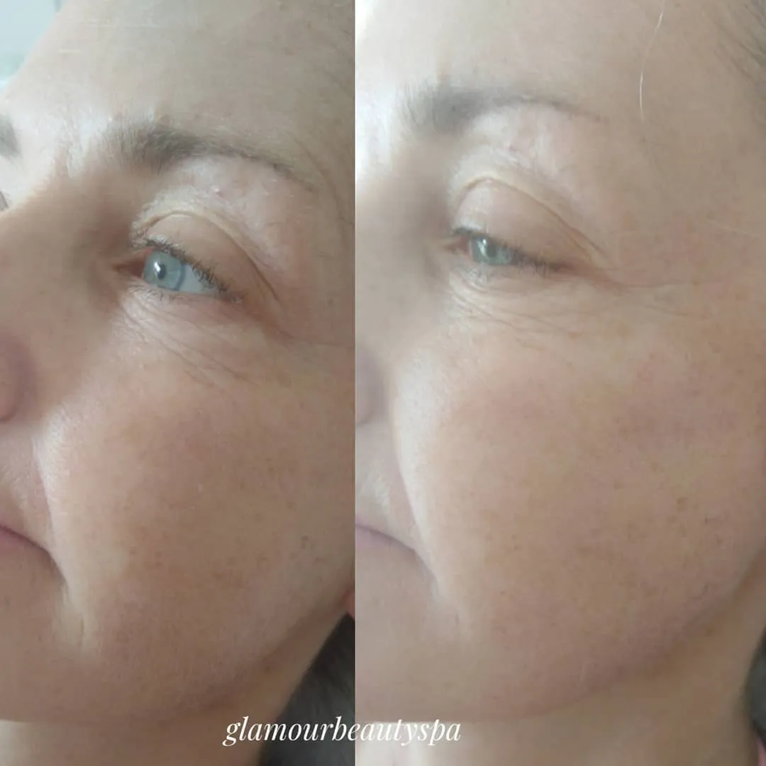 Eye area before and after mesotherapy treatment — Glamour Beauty & Spa, Athlone