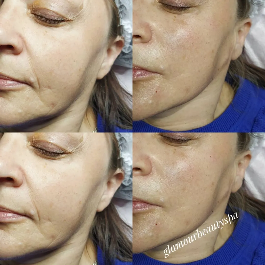 Facial skin before and after a course of treatments at Glamour Beauty & Spa