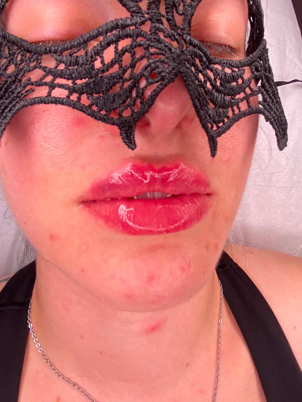 Freshly treated lips after hyaluronic filler, evenly balanced upper and lower lip — Glamour Beauty & Spa, Athlone