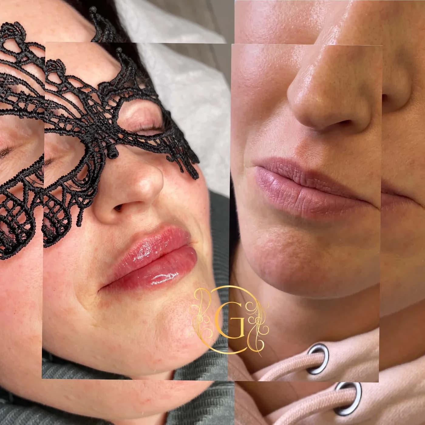 Lip filler before and after, showing restored volume and a defined border — Glamour Beauty & Spa, Athlone