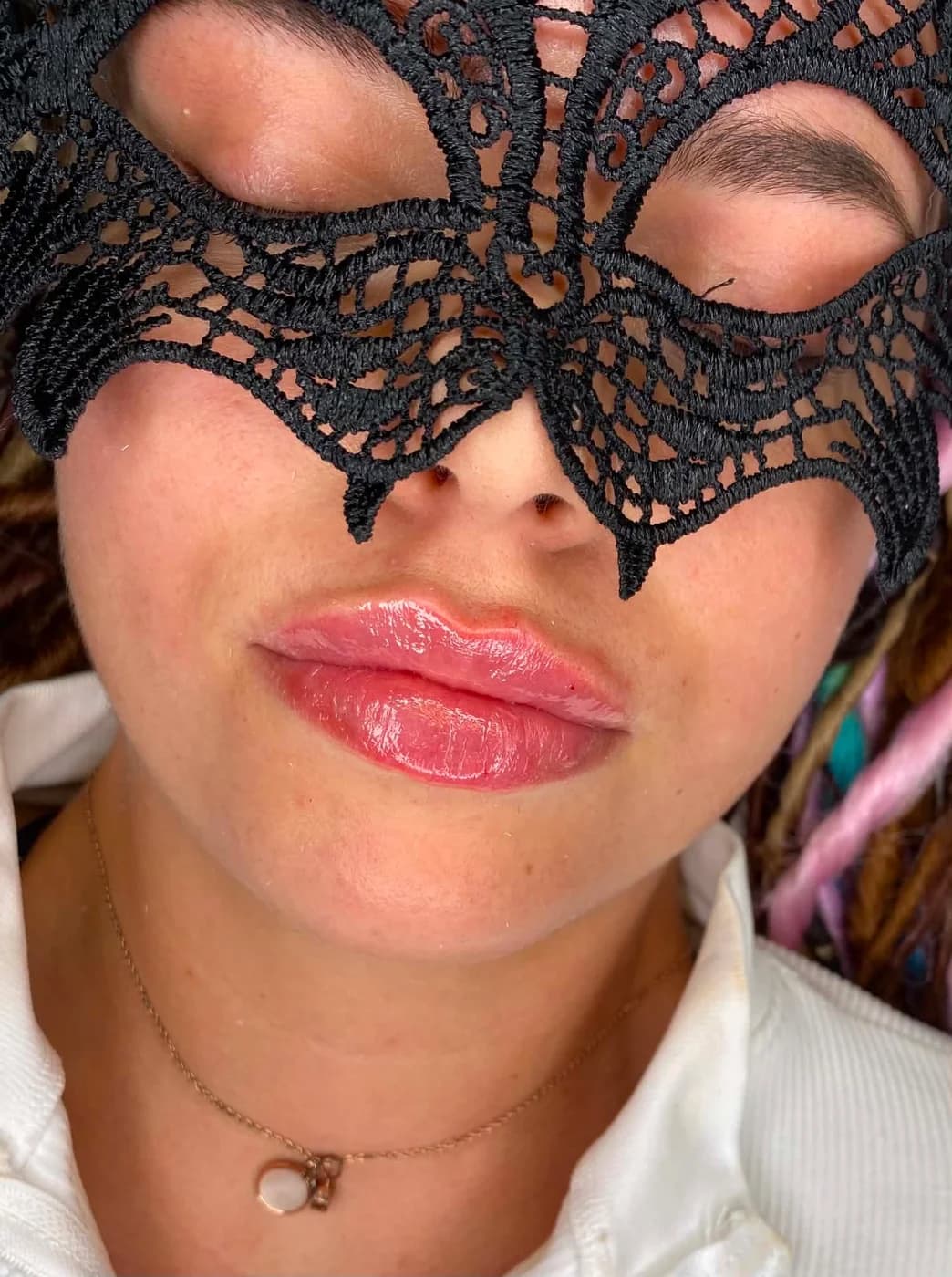 Close-up of a natural-looking lip enhancement with hyaluronic filler at Glamour Beauty & Spa